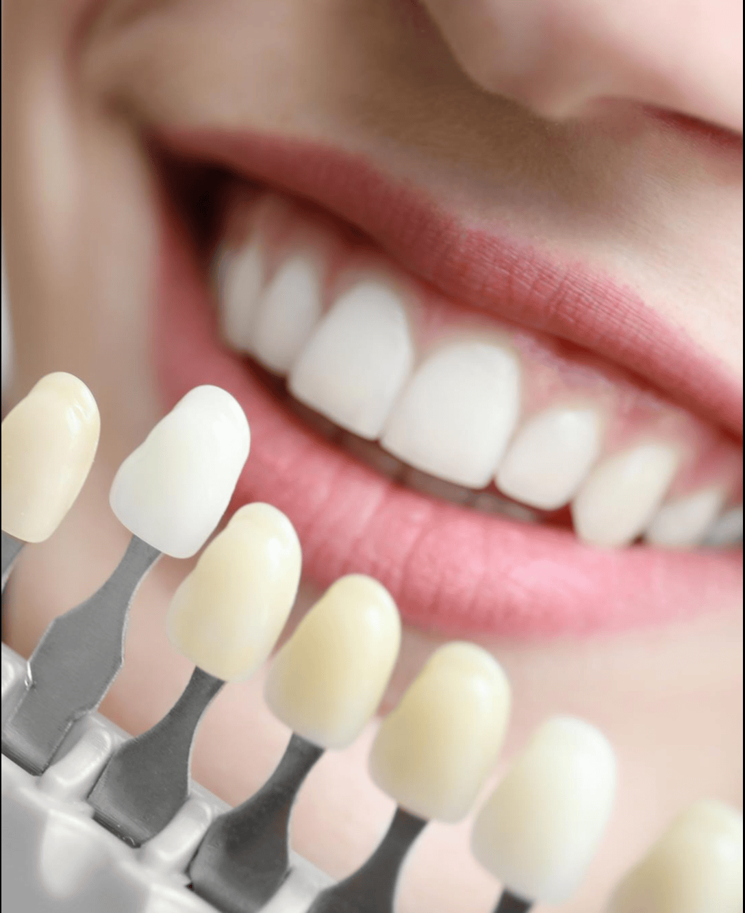Aesthetic Tooth Colored Fillings