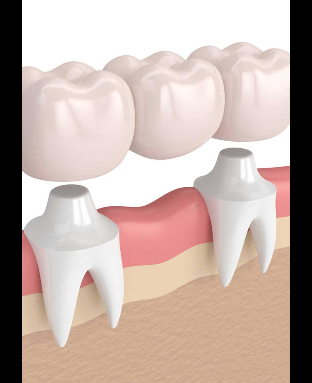 Dental Crowns & Bridges
