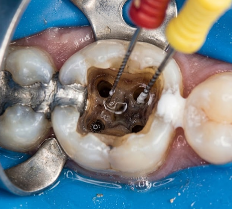 Root Canal Treatment