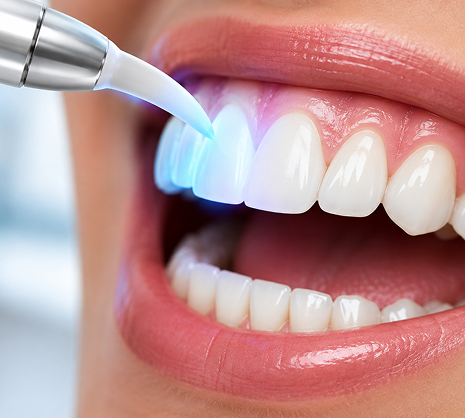 Teeth Whitening
