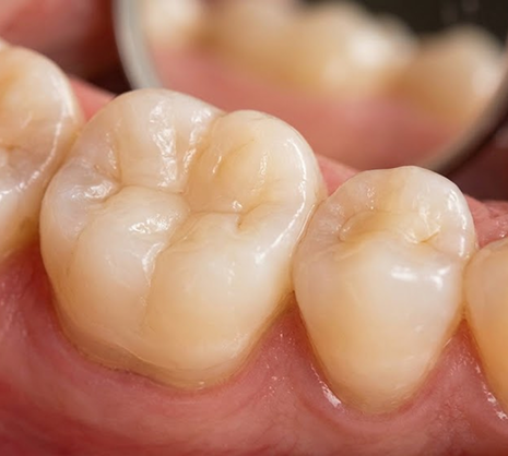 Aesthetic Tooth-Colored Fillings